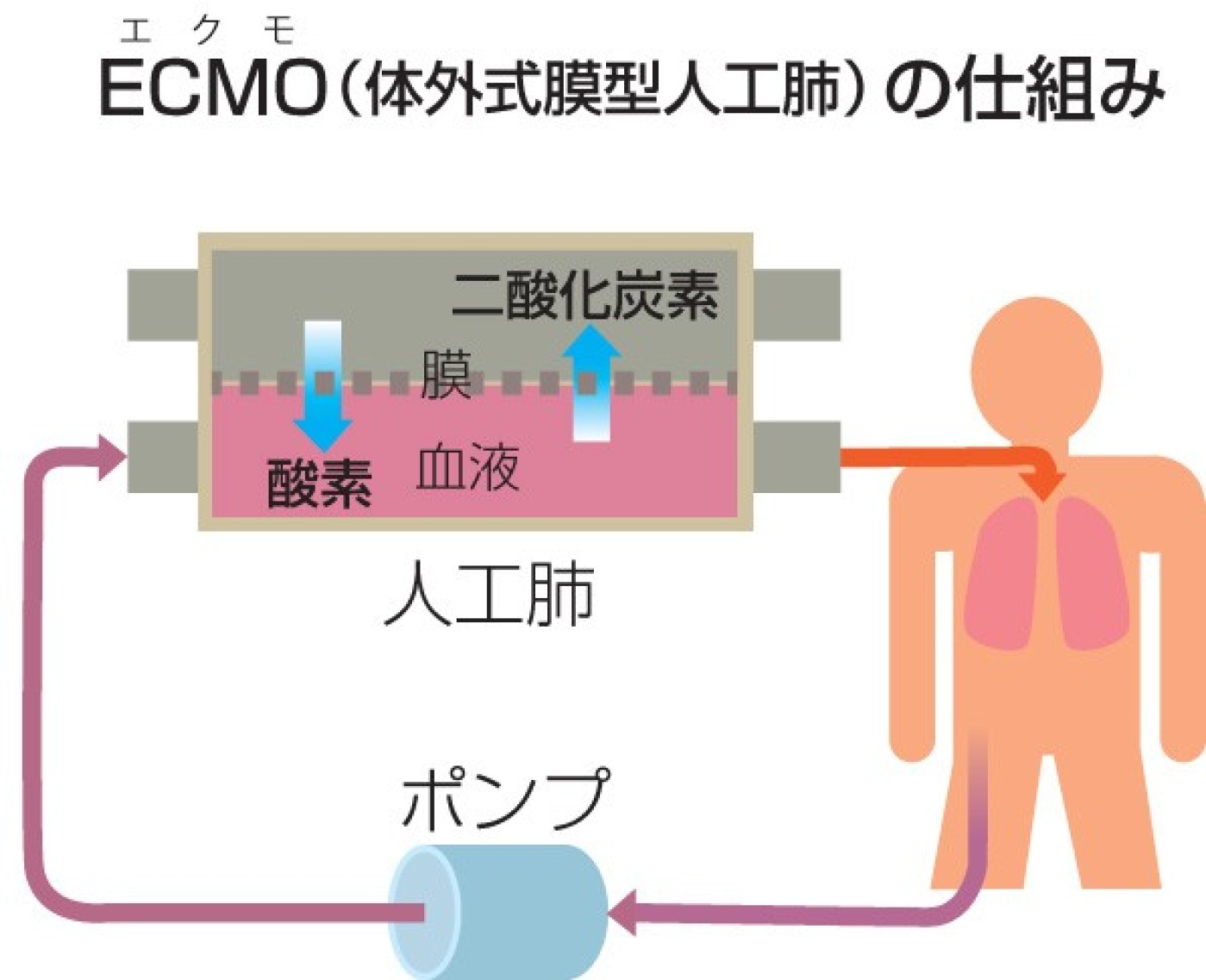 Q.ECMO(体外式膜型人工肺)ってどんな装置? : 東海大学新聞WEB版